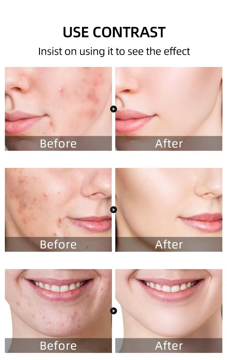 Wholesale Customized Salicylic Acid Acne Gel Plant Essence Cream Lotion for Fading Acne Marks Closed Pore Shrinkage Acne Removal