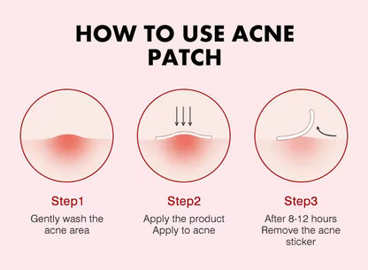 MOIKA Herbal Hydrocolloid Salicylic Acid Acne Patches Pimple Whitehead Facial Acne Removal 36 Patches Boxed for Wholesale