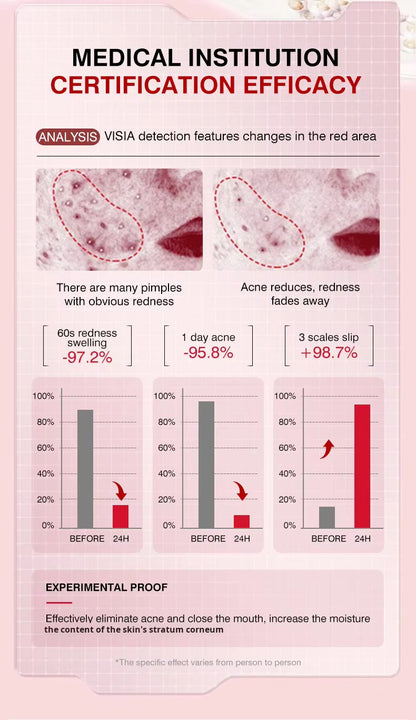 MOIKA Herbal Hydrocolloid Salicylic Acid Acne Patches Pimple Whitehead Facial Acne Removal 36 Patches Boxed for Wholesale