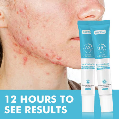Wholesale Customized Salicylic Acid Acne Gel Plant Essence Cream Lotion for Fading Acne Marks Closed Pore Shrinkage Acne Removal